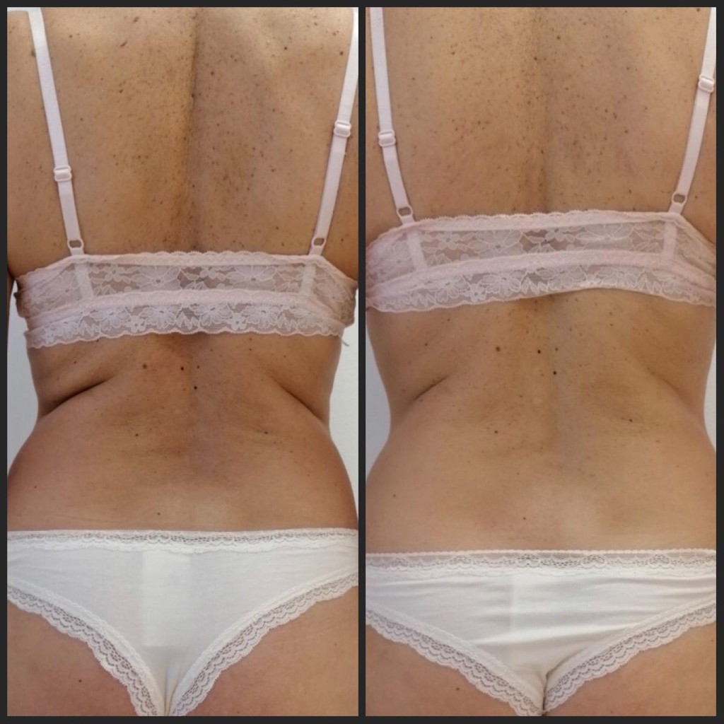 Adipologie behandeling