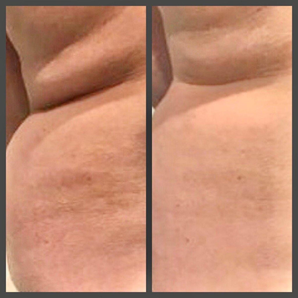 Adipologie behandeling