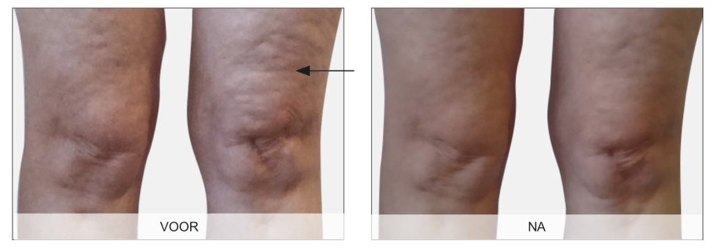 Endermologie voor het lichaam