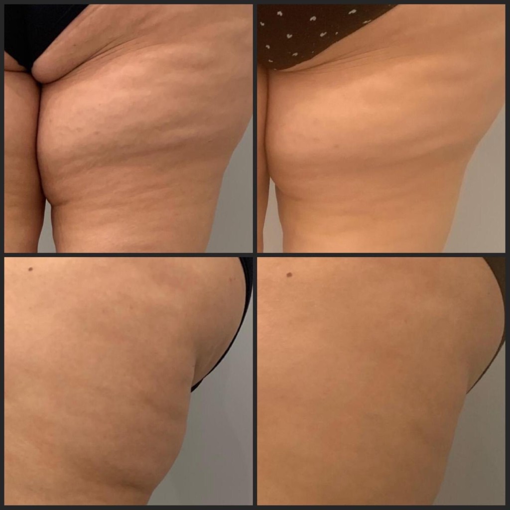 Adipologie behandeling