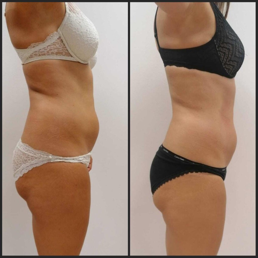 Adipologie behandeling