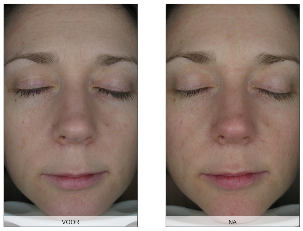 Endermologie voor het gezicht