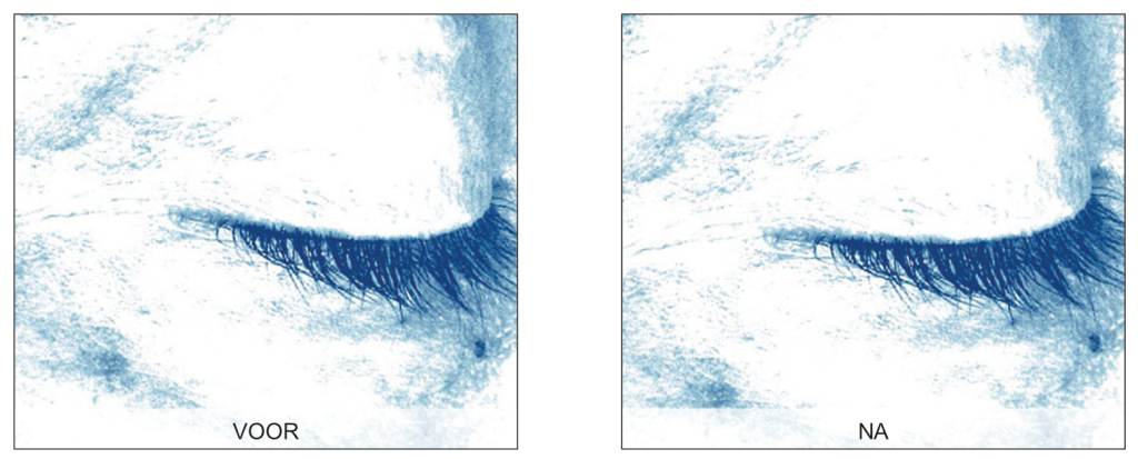 Endermologie voor het gezicht