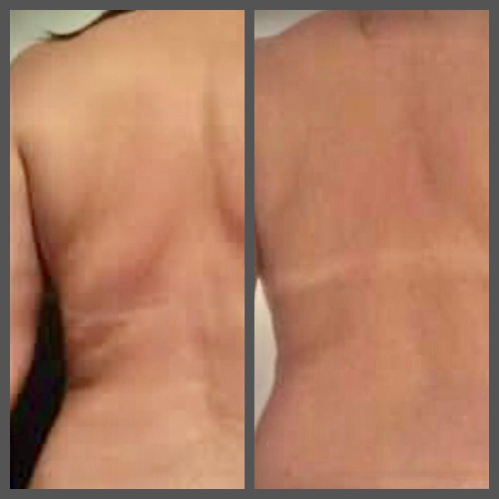 Adipologie behandeling